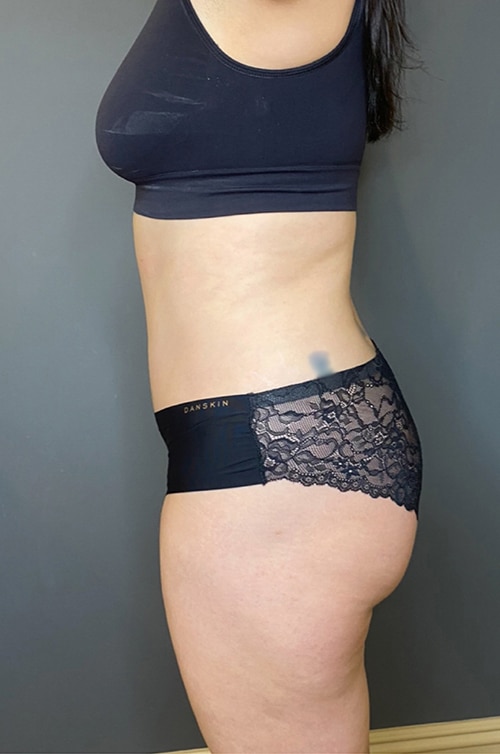 Tummy Tuck