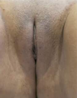 Labiaplasty