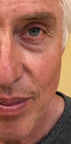 Fillers