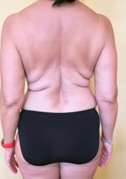 Liposuction