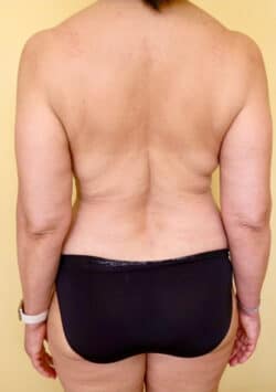Liposuction