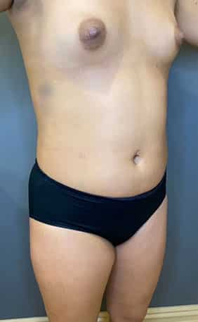 Breast Fat Grafting