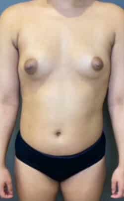 Breast Fat Grafting