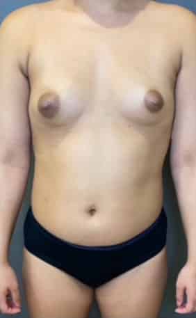 Breast Fat Grafting