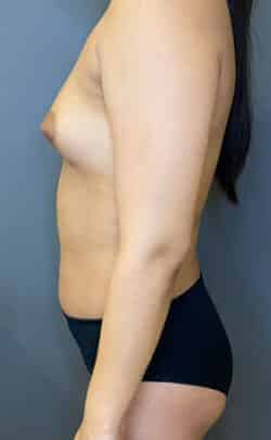 Breast Fat Grafting