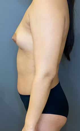 Breast Fat Grafting