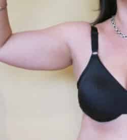 Liposuction