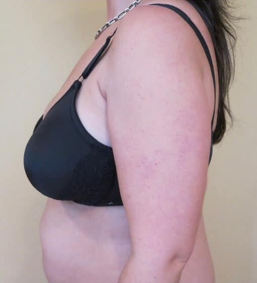 Liposuction