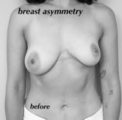 Breast Asymmetry
