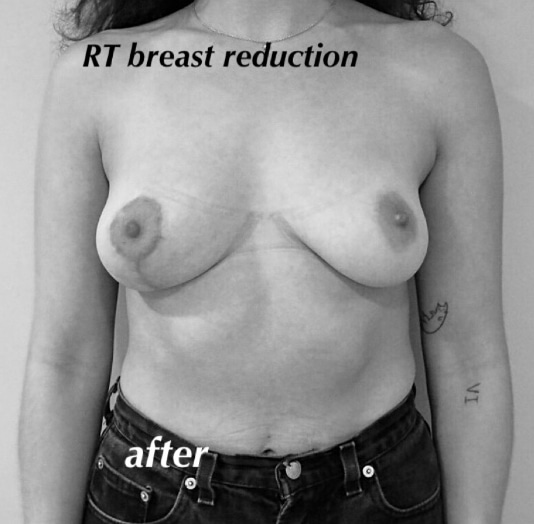 Breast Asymmetry