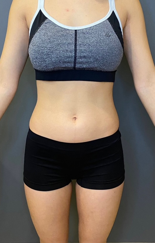 Liposuction