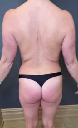 Breast Fat Grafting