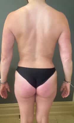 Breast Fat Grafting