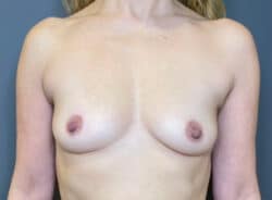 Breast Fat Grafting