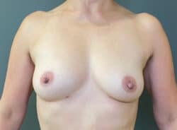 Breast Fat Grafting