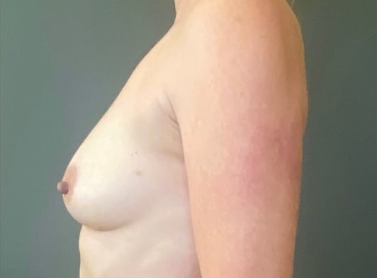 Breast Fat Grafting