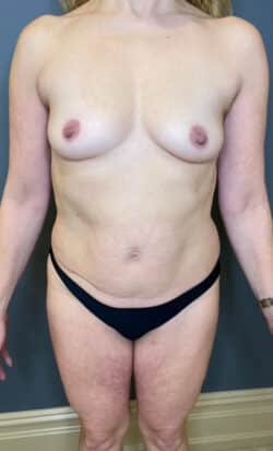 Breast Fat Grafting