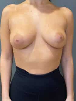 Breast Augmentation (Implants)
