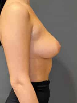 Breast Augmentation (Implants)