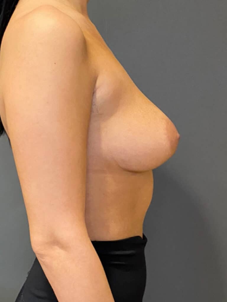 Breast Augmentation (Implants)