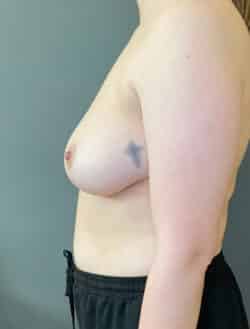Breast Implant Revision (Explant)