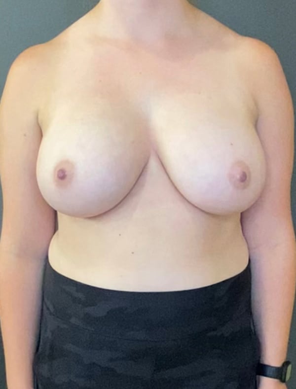 Breast Implant Revision (Explant)