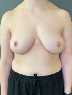 Breast Implant Revision (Explant)