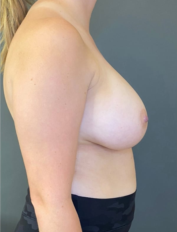 Breast Implant Revision (Explant)