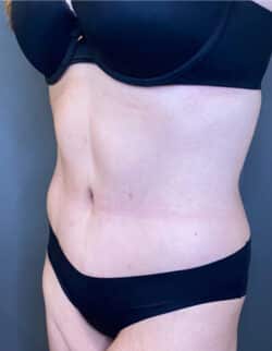 Tummy Tuck