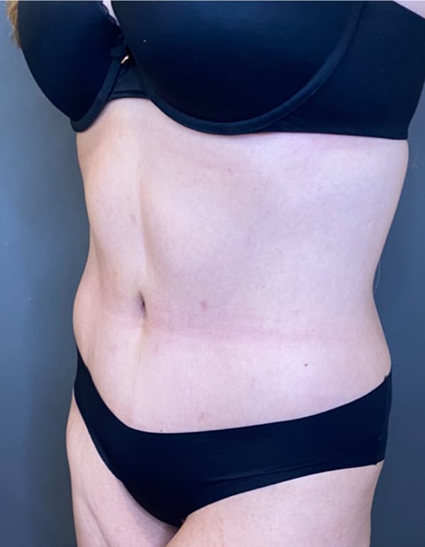 Tummy Tuck