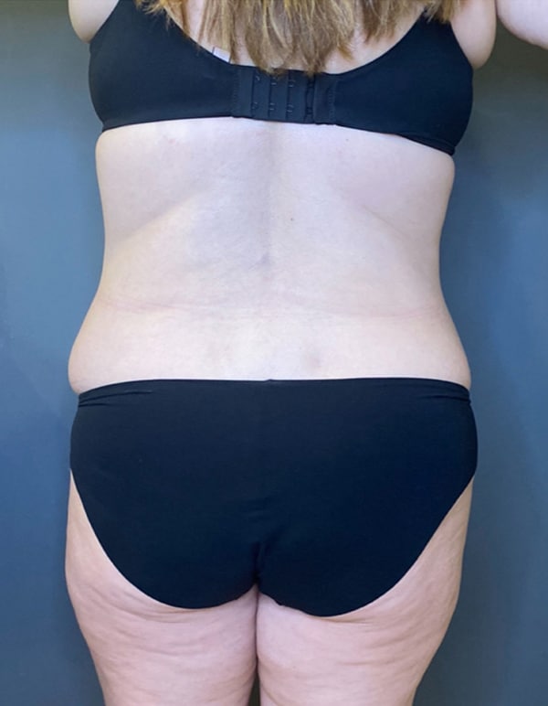 Tummy Tuck