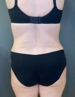Tummy Tuck