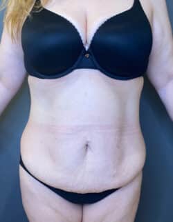 Tummy Tuck