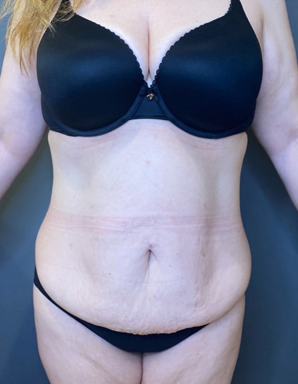 Tummy Tuck