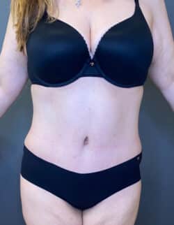 Tummy Tuck