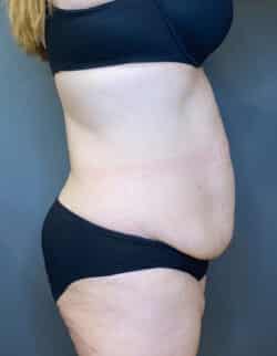 Tummy Tuck