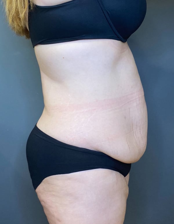 Tummy Tuck