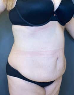 Tummy Tuck