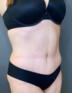Tummy Tuck