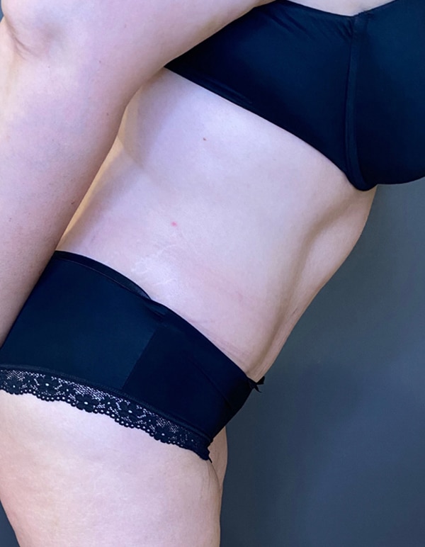 Tummy Tuck
