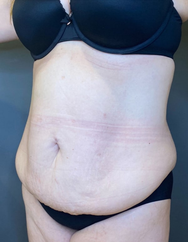 Tummy Tuck
