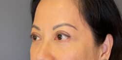 Eyelid Tuck