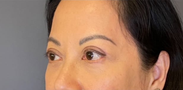 Eyelid Tuck