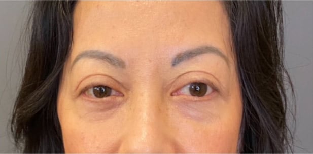 Eyelid Tuck