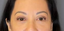 Eyelid Tuck