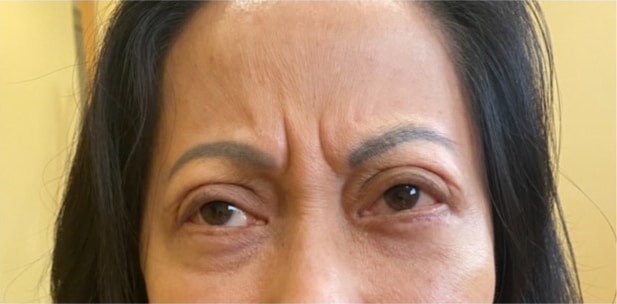 Eyelid Tuck