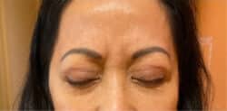 Eyelid Tuck