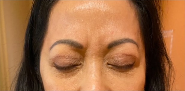 Eyelid Tuck