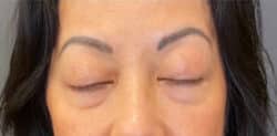 Eyelid Tuck