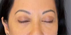 Eyelid Tuck